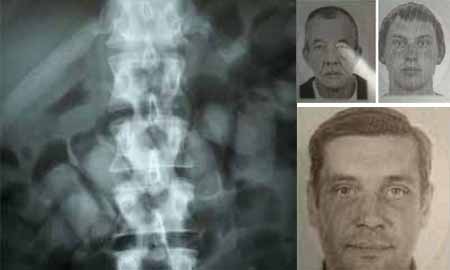 Dois poloneses expelem cápsulas de droga; um ainda está com cerca de 50 no estômago