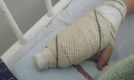 Criança de 4 anos tem dedo decepado em escorregador enferrujada de escola de Ourinhos