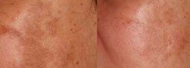 Médica fala sobre as novidades no tratamento do Melasma