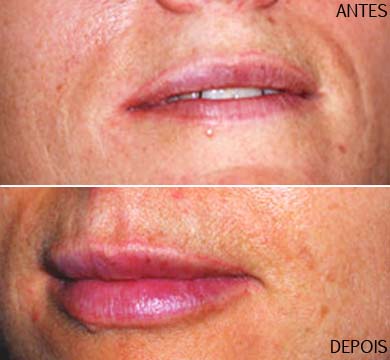 Especialista em dermatologia fala sobre os mitos e verdades do preenchimento labial