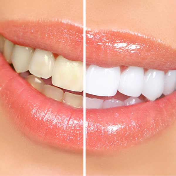 É possível ter os dentes mais brancos e com segurança!!
