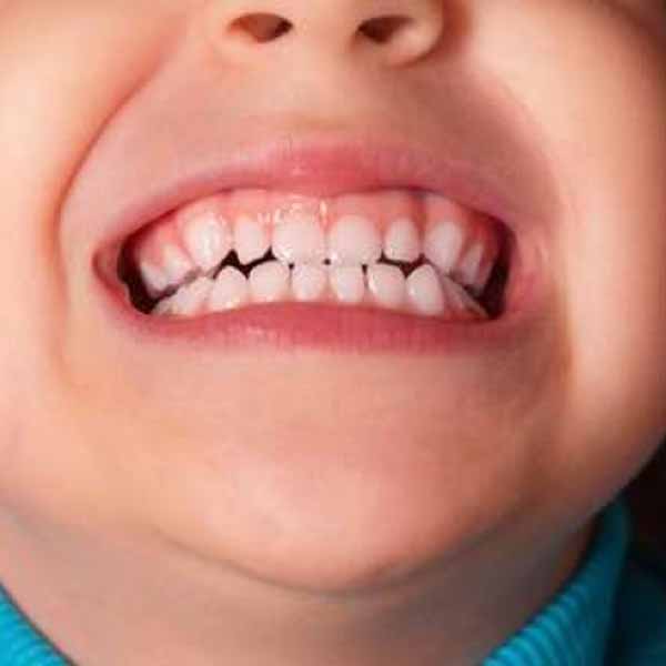 Qual a importância e porque cuidar dos dentes de “leite”?