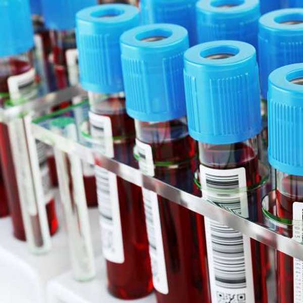 Alzheimer: exame de sangue poderia prever risco da doença