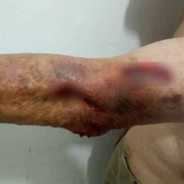 'Eu gritava, mas ele tampava a boca', diz idoso amarrado e queimado com cigarro durante assalto