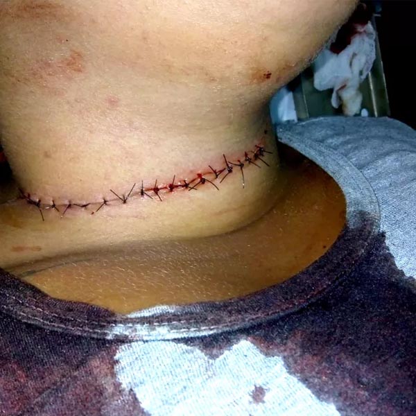 Motociclista leva 19 pontos no pescoço após ser atingida por linha de cerol em Tupã