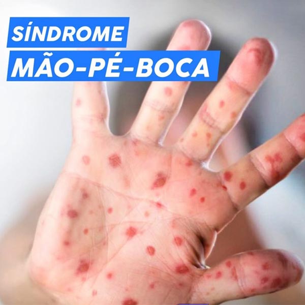 Saúde de Paraguaçu enfrenta surto da síndrome 'mão-pé-boca'