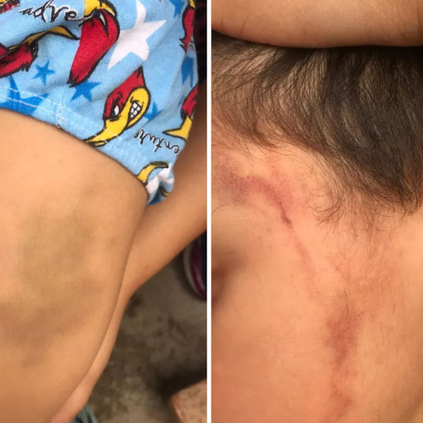 Polícia investiga mãe e padrasto por suspeita de maus-tratos a garoto de 4 anos em Assis