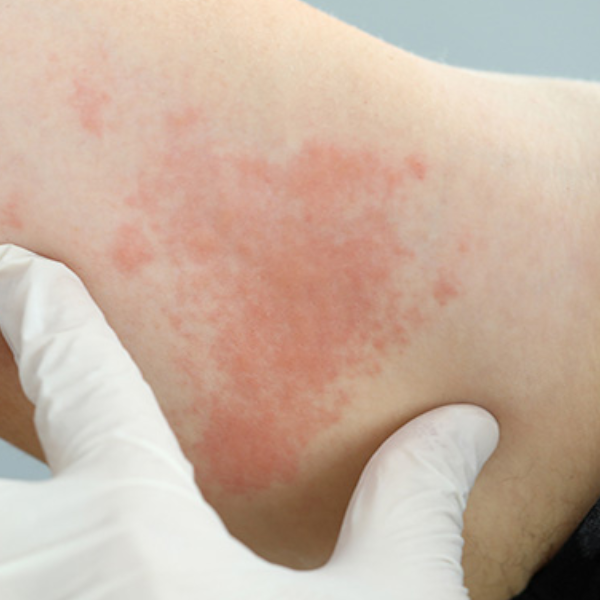 Irritação na pele no verão, alergista explica brotoejas e urticária
