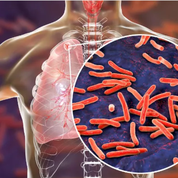 Exames para diagnosticar tuberculose crescem 149% na rede pública