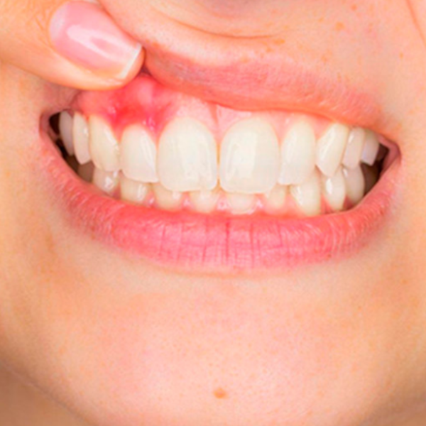 Câncer de boca: doença pode passar despercebida e ser confundida com problemas de saúde bucal