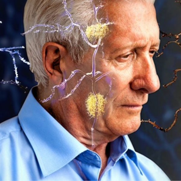 Alzheimer começa sem sintoma de demência; veja as 7 fases da doença