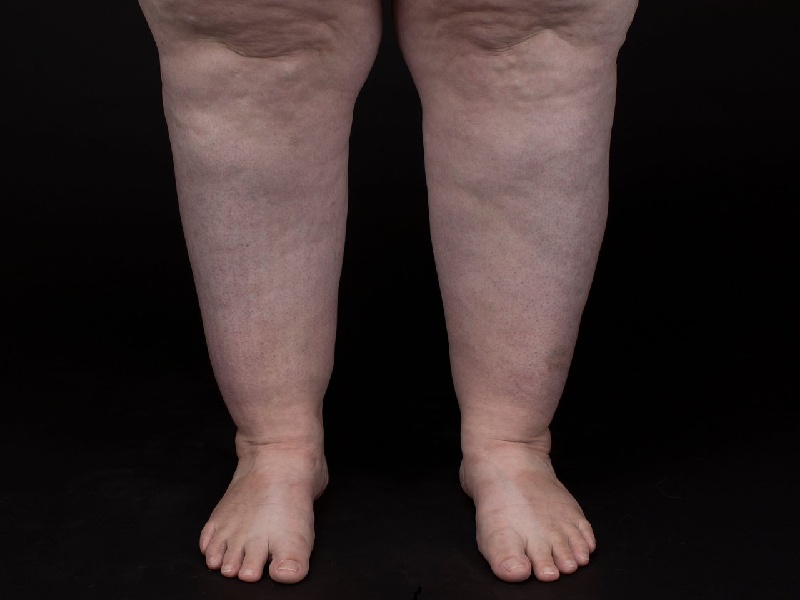 Lipedema desafia diagnóstico e impacta a saúde feminina
